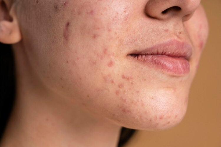 Skin Barrier
